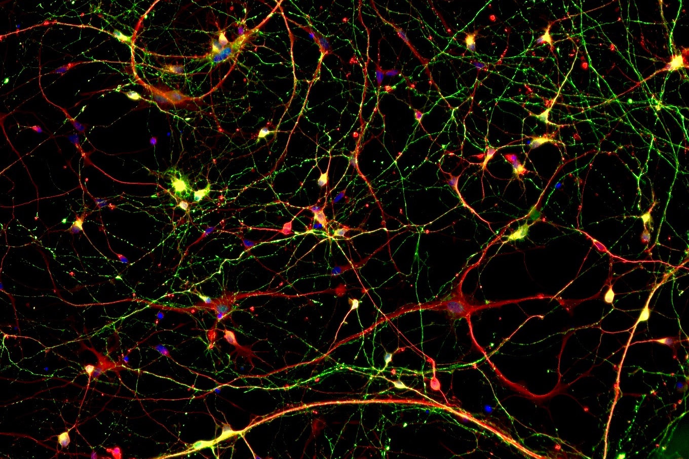 IPSC derived neurons from a patient with Alzheimer's disease